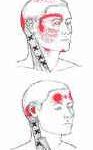 הקרנות כאב של טריגרים על שריר מפנה הראש - גבעון פלד